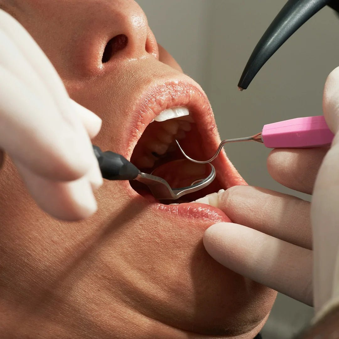 Péče o chrup po vytržení zubů - LYSS.cz