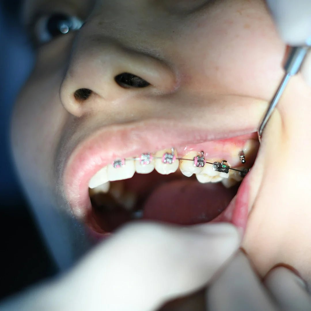 Péče o zuby s rovnátky - LYSS.cz